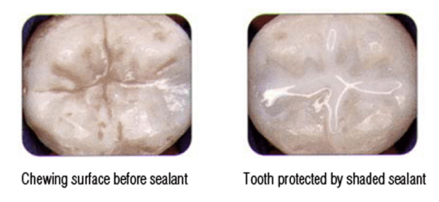 Comparison pictures of a tooth without a dental sealant coating and after it's been coated.
