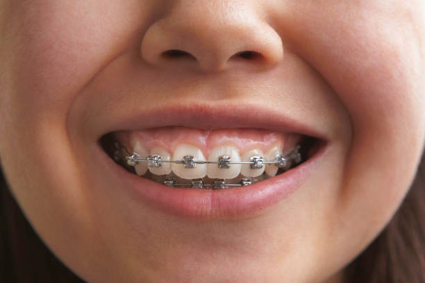 Up close picture of a child smiling with braces