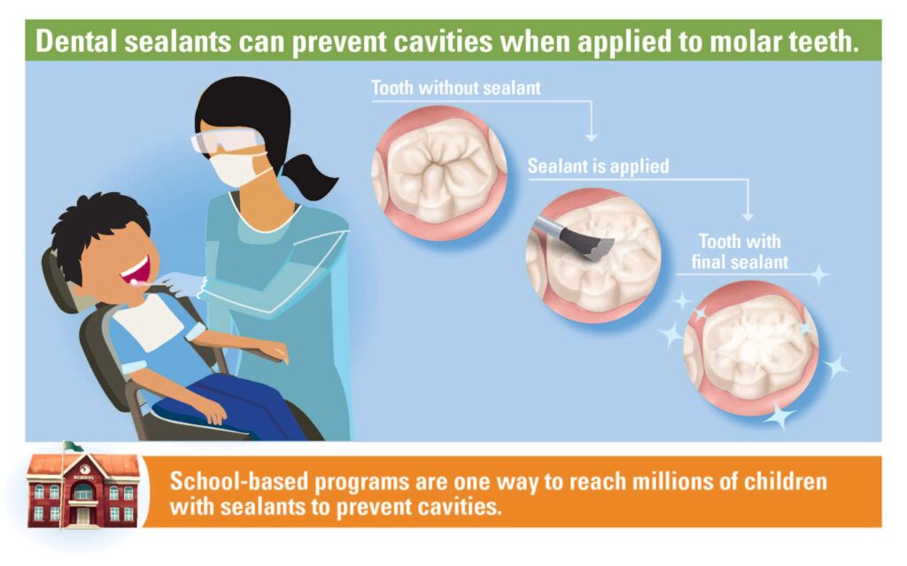 Animated image of a dentist applying dental sealants to a child's tooth, and a close-up view of what the tooth looks like.