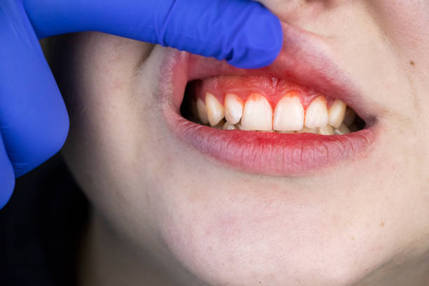 A person wearing a blue glove lifts a child's upper lip to show bleeding gums